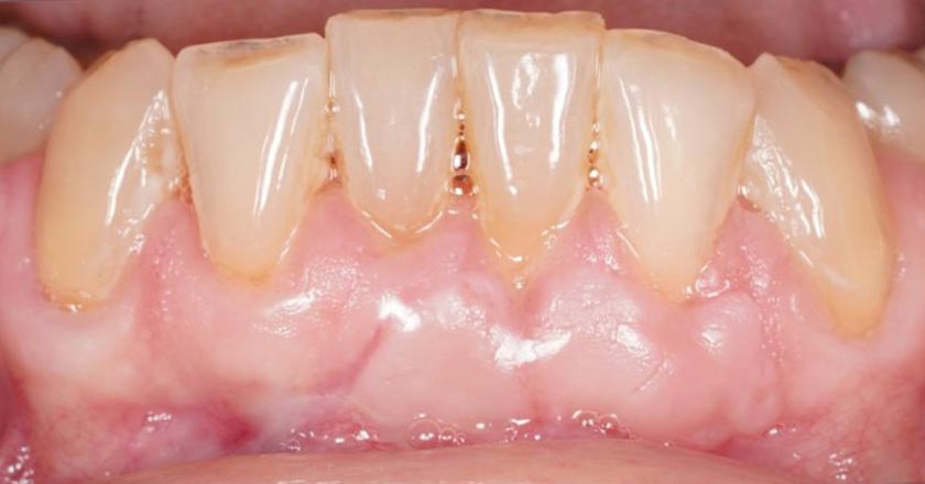 Gum graft lower – after treatment