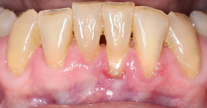 Gum graft lower – before treatment