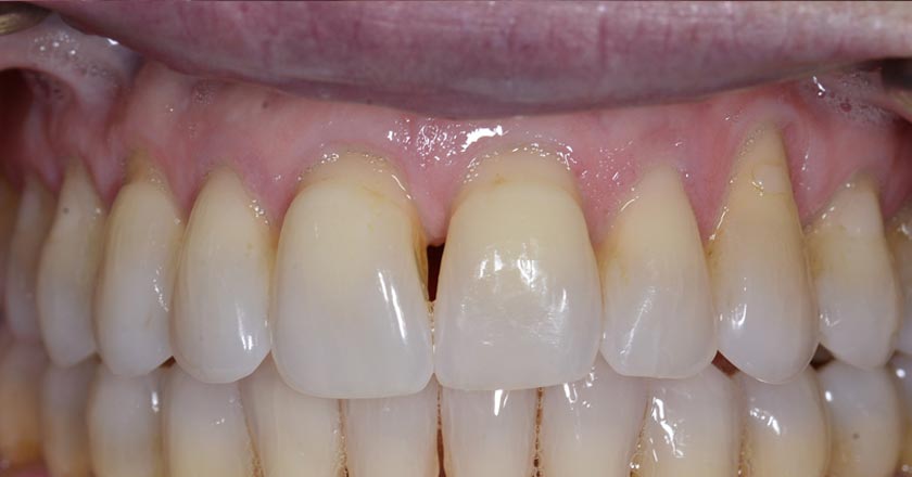 Gum graft upper – before treatment