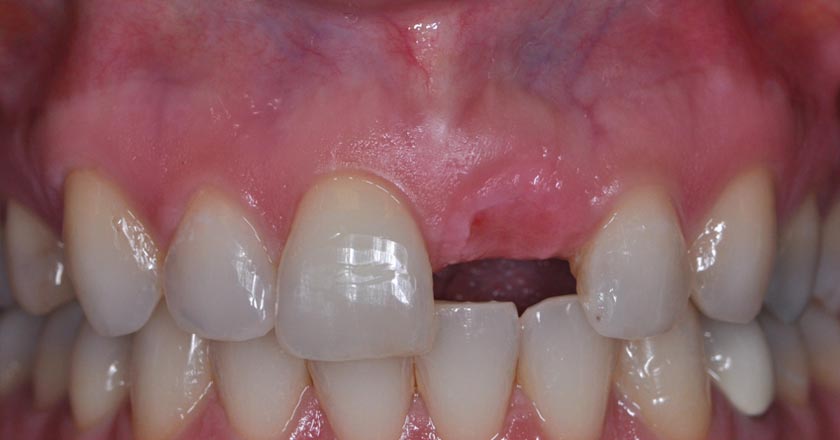 Dental implant – before procedure