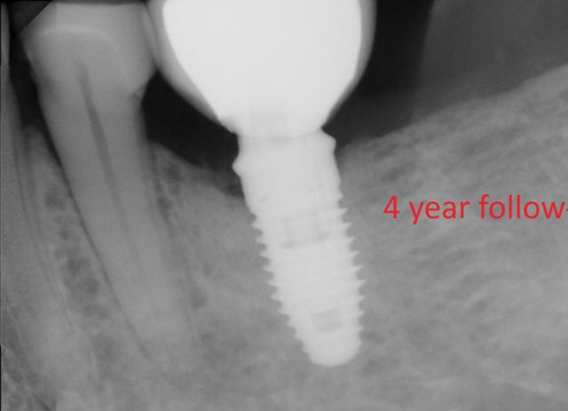 Implant bone grafting – after surgery