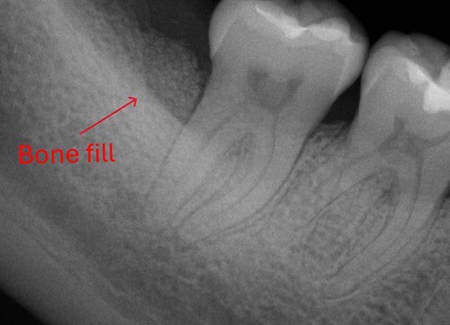 Tooth bone grafting – after procedure