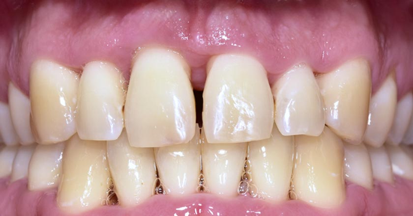 Gum disease scaling and root planing – after treatment