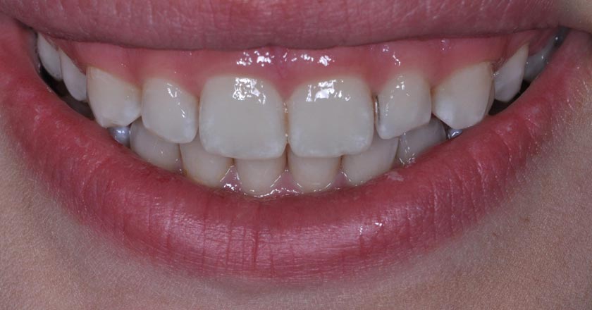 Gummy smile correction – before treatment 1